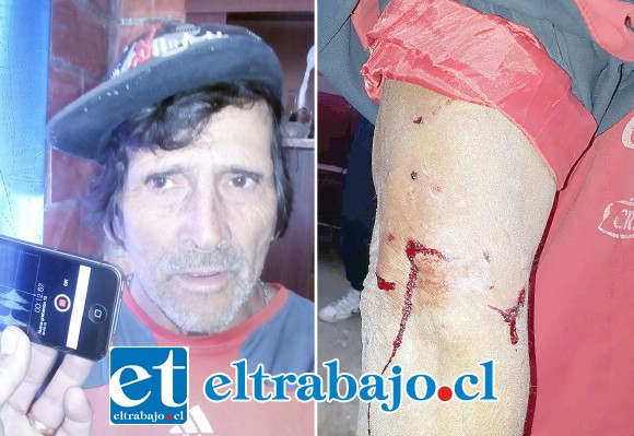 Carlos Acevedo López, cuyo brazo asegura fue mordido por un perro de Carabineros.