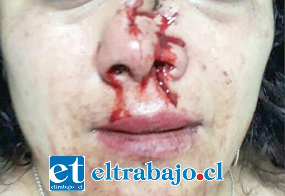 Esta imagen difundida por redes sociales muestra el rostro de la joven mujer cobardemente agredida, quien sufrió una grave fractura nasal y pérdida de piezas dentales.