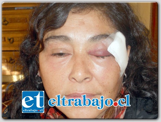 MUY GOLPEADA.- La conductora de transporte escolar del Colegio Alonso De Ercilla, Viviana Tapia Moreno, muestra a las cámaras de Diario El Trabajo cómo quedó su rostro tras la agresión.