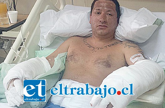 En proceso de recuperación en el Hospital del Trabajador en la ciudad de Santiago, se encuentra el chef argentino Gustavo Macías Amaya (30), quien el martes de la semana pasada sufrió serias quemaduras en su rostro, abdomen y extremidades superiores.