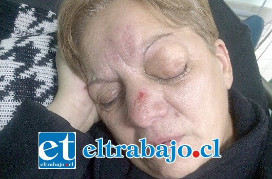 Nelly Argomedo Cornejo, de 60 años, sufrió una criminal golpiza al ser asaltada. (Foto EmergenciaVCordillera).