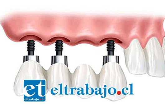 Mayores de 60 años a 75 años, y que no tienen piezas dentales en su mandíbula. Cada uno de ellos será rehabilitado con prótesis acrílica removible, más dos implantes dentales