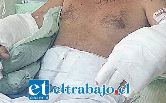 Con quemaduras bastante complejas que abarcan el 30 por ciento de su cuerpo resultó el trabajador tras la explosión del gas emanado del diluyente. (Foto archivo referencial)