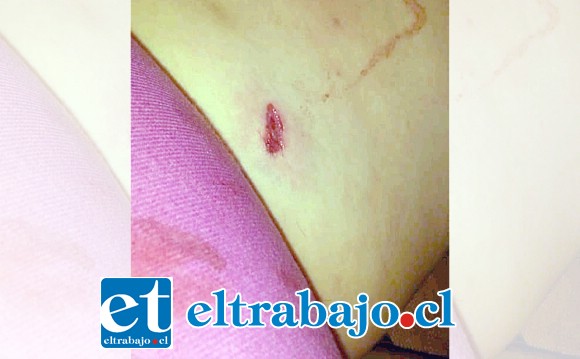 Esta es la herida de la bala en la pierna izquierda de Romina Cataldo. (Foto gentileza Radio Acocagua).