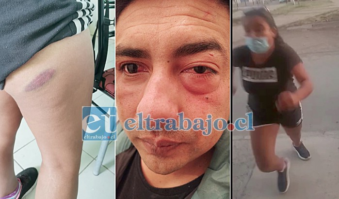 LA HISTORIA EN TRES FOTOS.- En el cuadro primero vemos el hematoma del martillazo que recibió Azucena Gómez; al centro se ve Sebastián Cisternas tras la inesperada visita, y a la derecha vemos el instante cuando la joven Azucena se lanzó violentamente contra Sebastián.