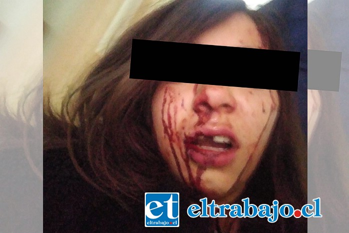 COBARDES.- Así quedó el rostro de la joven Francisca, de sólo 18 años de edad, quien fue salvajemente agredida por alrededor de diez amigos de su expololo (tres hombres y las demás mujeres).