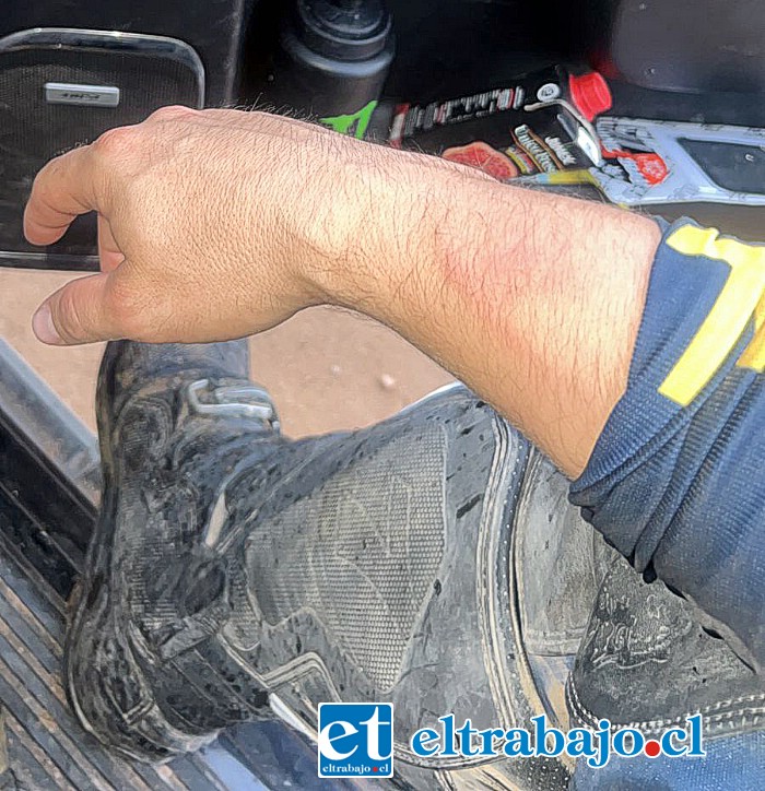 Una fisura en su brazo sufrió Javier tras el accidente, además de esguinces en 7 de sus dedos de ambas manos.