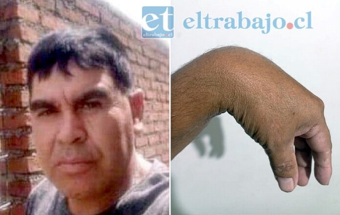 Samuel Muñoz Navarrete, afectado por malas cirugías que lo dejaron lisiado de una mano.