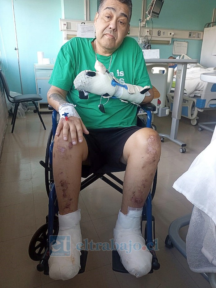 Israel Gallardo, sentado sobre su sillas de ruedas, internado en el Hospital San Camilo producto de una diabetes.