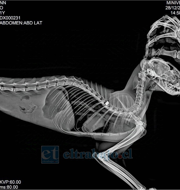 La radiografía lateral de columna evidencia el postón alojado en el canal medular, causante de la paraplejia y la complicación con su vejiga.