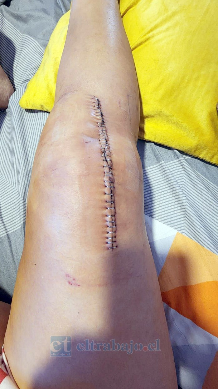 Fotografía que demuestra la operación de Sara Riquelme en su rodilla derecha.