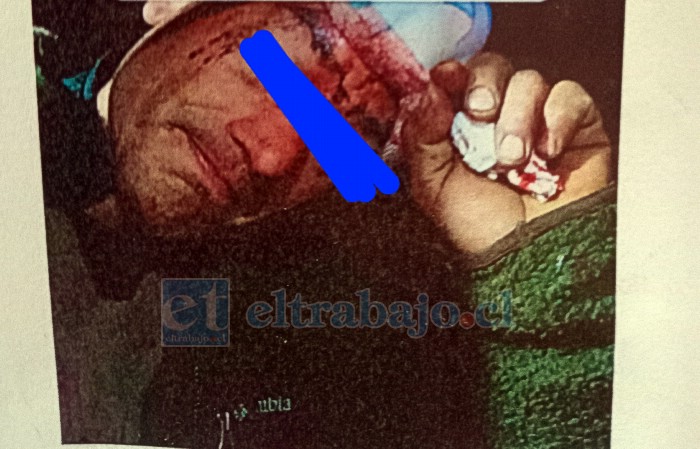 Su amigo herido, según relata, por un hacha.