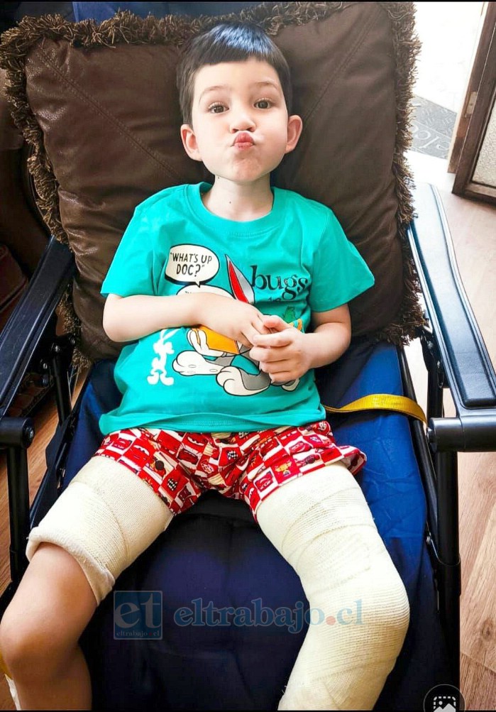 Ángel Martínez Lazcano, de 5 años de edad, lleva cerca de cuatro meses sin poder caminar debido a un tumor en el fémur de su pierna izquierda.