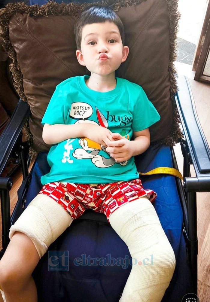 Ángel Martínez Lazcano, de 5 años de edad, lleva cerca de cuatro meses sin poder caminar debido a un tumor en el fémur de su pierna izquierda.