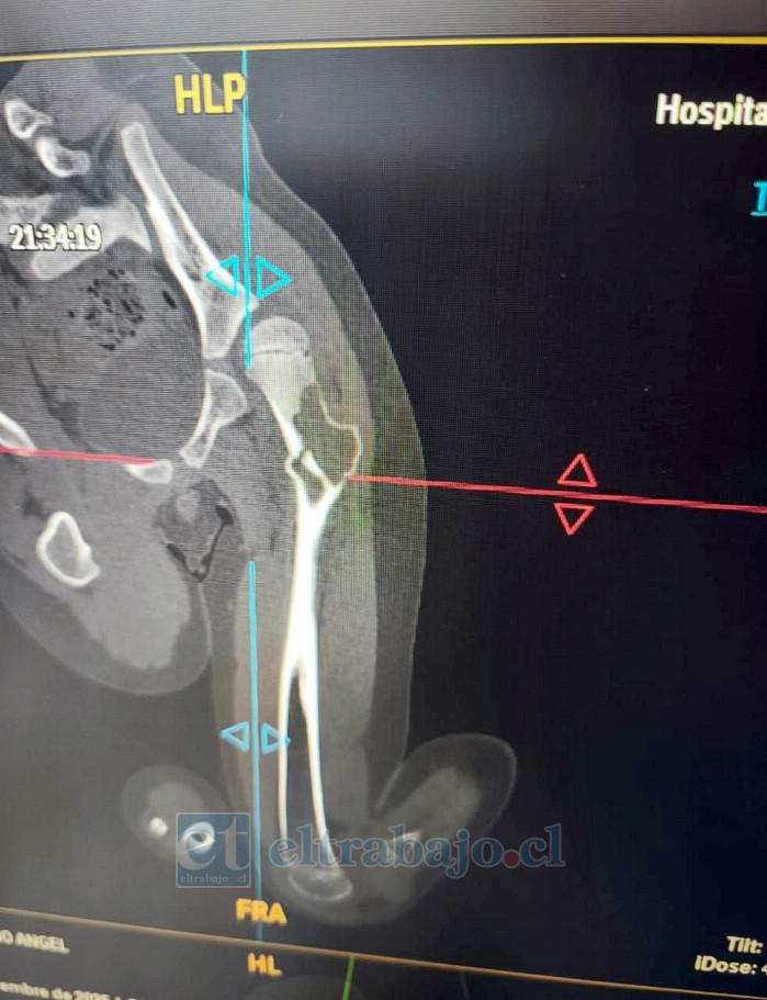 Radiografía donde se observa el tumor en el fémur izquierdo.