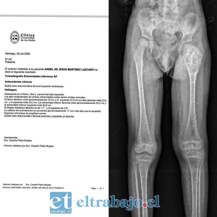 Radiografía actual de Ángel, donde se observa el tumor y, según lo señalado por los resultados del examen, la diferencia de altura entre ambas cabezas femorales producto de las secuelas que presenta en su pierna izquierda.